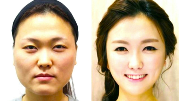 Пластические операции в Корее