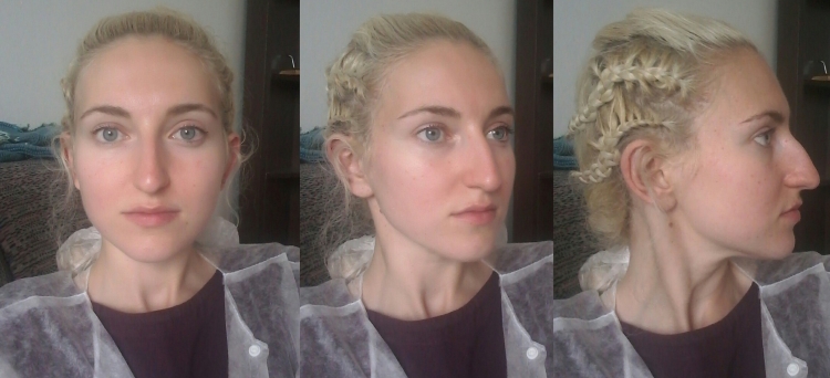 Норик фенотип