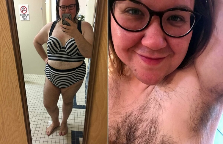 Бодипозитив гирсутизм