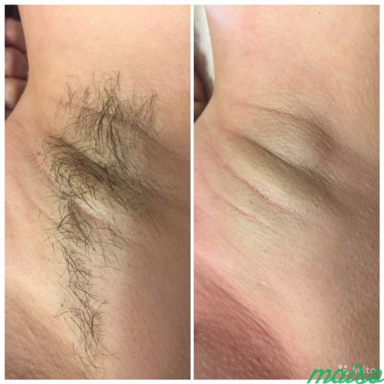 Эпиляция лобковых волос