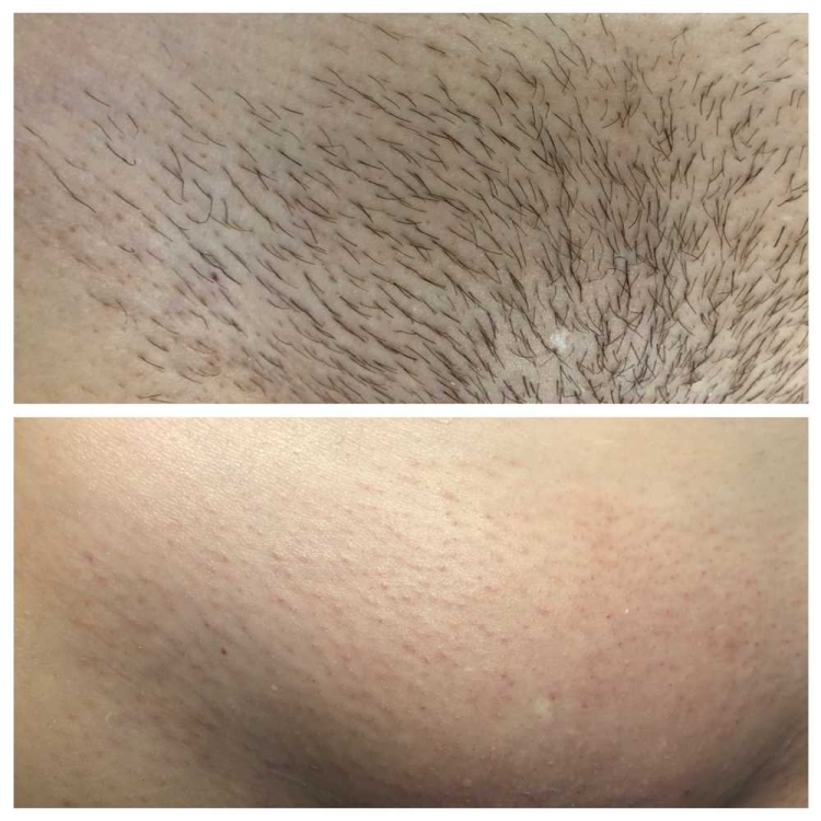 Депиляция шугаринг глубокое бикини