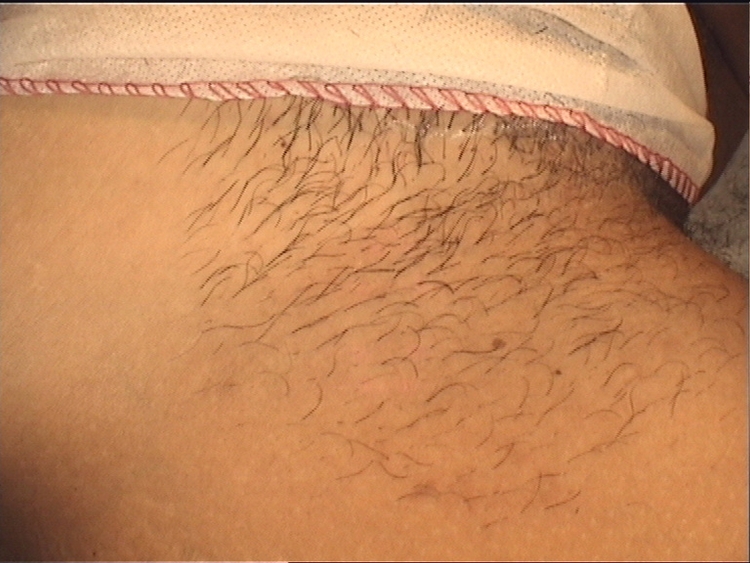 Лобковые волосы женские