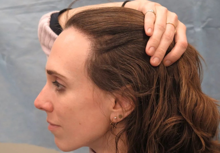 Залысины у женщин