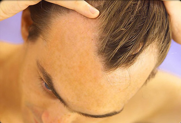 Облысение по бокам