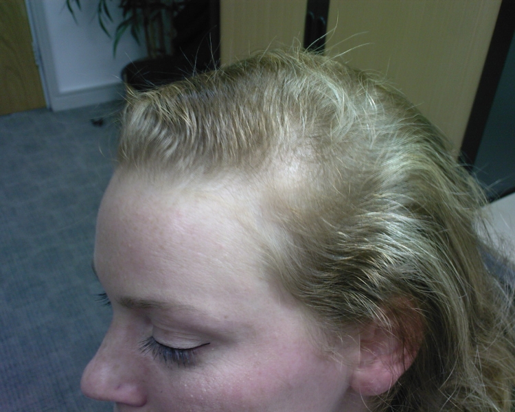 Гиперандрогенная алопеция