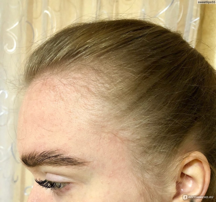 Волосы у висков