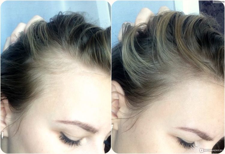 Высокая линия роста волос