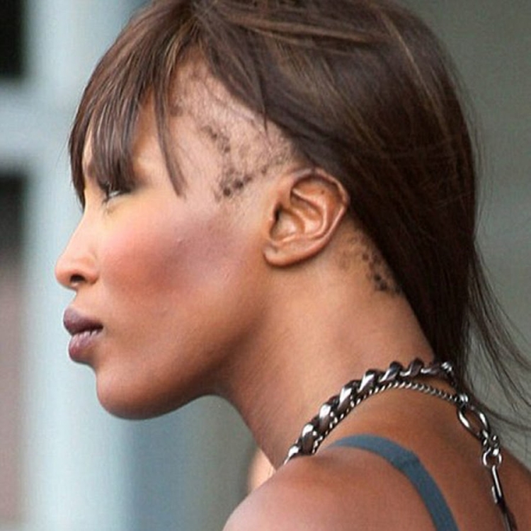 Алопеция у знаменитостей фото