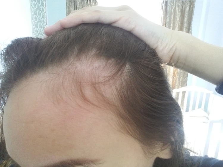 Лобные залысины у женщин