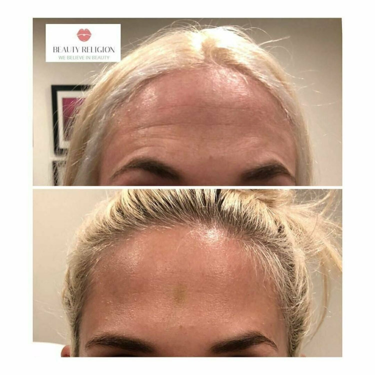 Волосы после ботокса