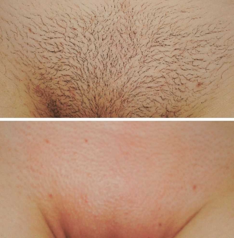 Эпиляция бикини глубокое