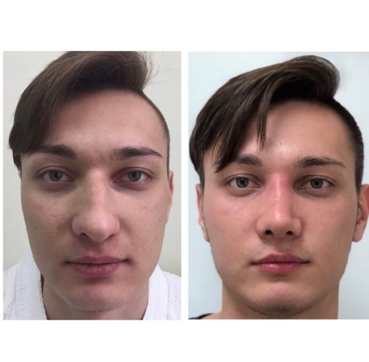 Ринопластика носа мужчины до и после