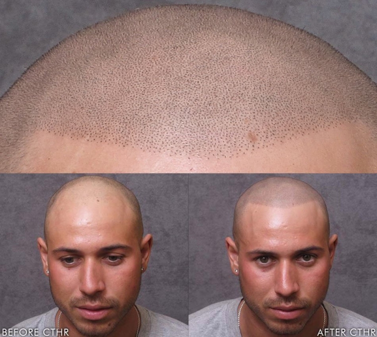 Трихопигментация скальпа