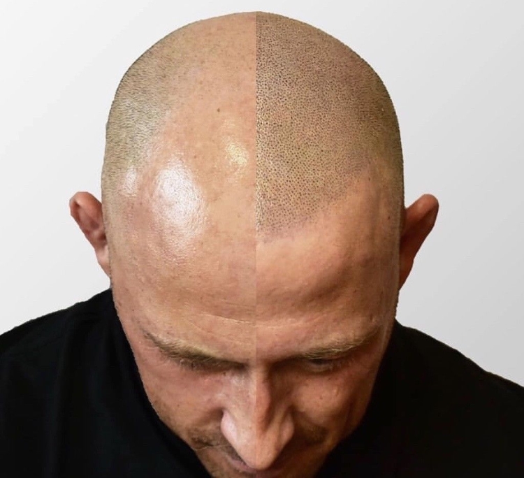 Трихопигментация скальпа