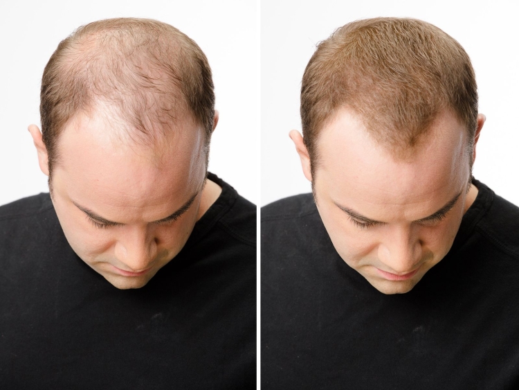 Прически с лысиной на голове