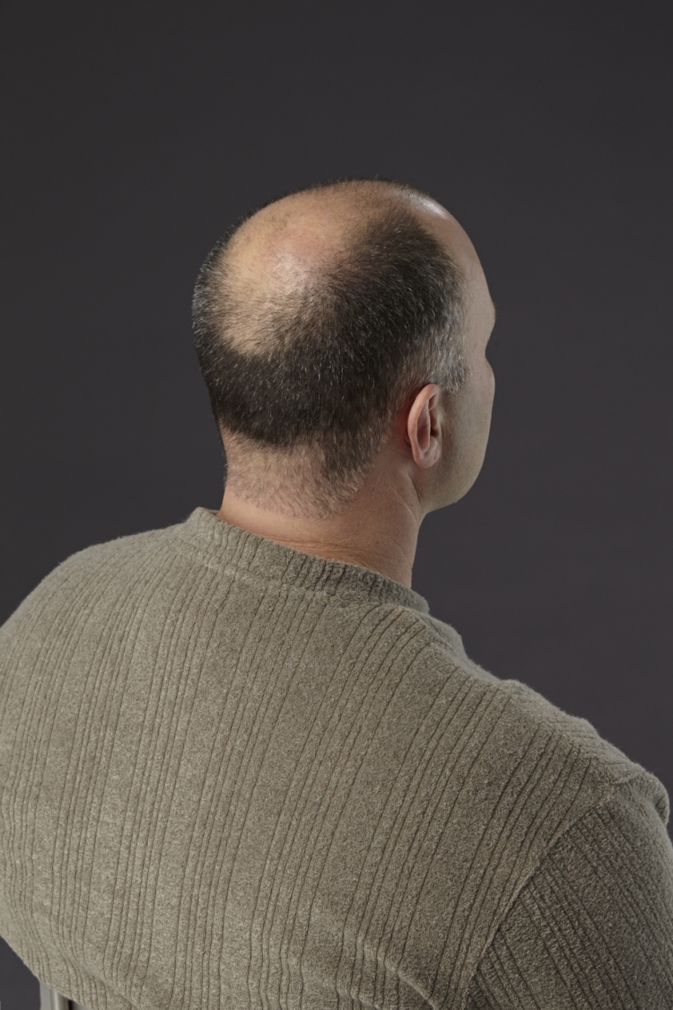 Причёски с лысиной на макушке