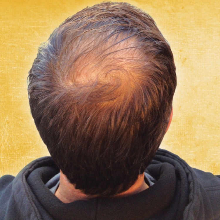 Лысина на макушке