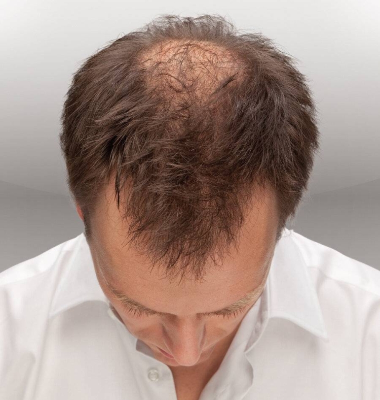 Стрижка с лысиной на макушке