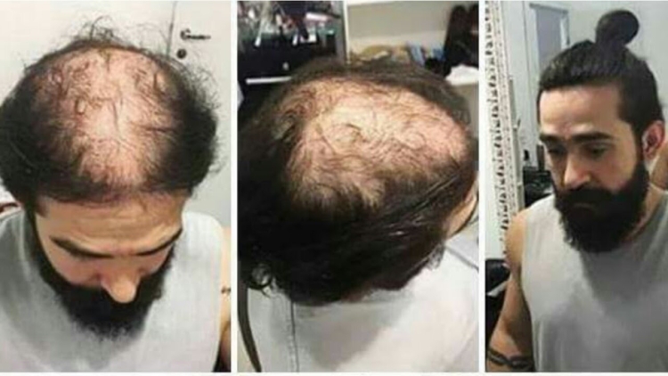 Причёски с лысиной на макушке